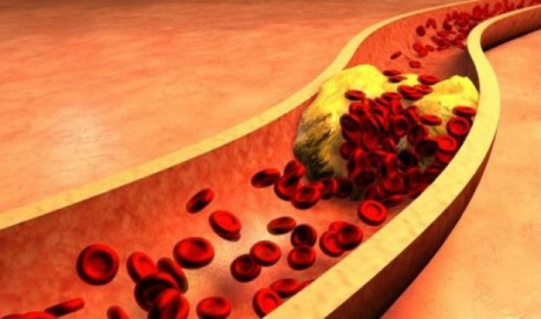 Ja si ti eliminojmë yndyrnat në gjak në mënyrë natyrale